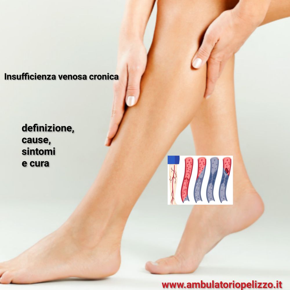 insufficienza venosa cronica, cause sintomi e cura